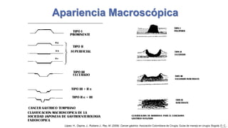 Apariencia Macroscópica

López, H., Ospina, J., Rubiano J., Rey, M. (2009). Cancer gástrico. Asociación Colombiana de Cirugía, Guías de manejo en cirugía. Bogotá, D. C.,

 