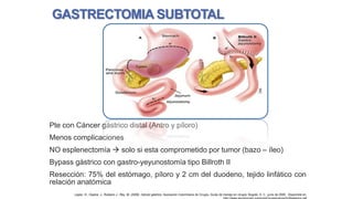 GASTRECTOMIA SUBTOTAL

Pte con Cáncer gástrico distal (Antro y píloro)
Menos complicaciones
NO esplenectomía  solo si esta comprometido por tumor (bazo – íleo)
Bypass gástrico con gastro-yeyunostomía tipo Billroth II
Resección: 75% del estómago, píloro y 2 cm del duodeno, tejido linfático con
relación anatómica
López, H., Ospina, J., Rubiano J., Rey, M. (2009). Cáncer gástrico. Asociación Colombiana de Cirugía, Guías de manejo en cirugía. Bogotá, D. C., junio de 2009. Disponible en:

 