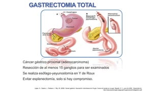 GASTRECTOMIA TOTAL

Cáncer gástrico proximal (adenocarcinoma)
Resección de al menos 15 ganglios para ser examinados
Se realiza esófago-yeyunostomía en Y de Roux
Evitar esplenectomía, solo si hay compromiso.
López, H., Ospina, J., Rubiano J., Rey, M. (2009). Cancer gástrico. Asociación Colombiana de Cirugía, Guías de manejo en cirugía. Bogotá, D. C., junio de 2009. Disponible en:
http://www.ascolcirugia.org/guiasCirugia/cancer%20gastrico.pdf

 