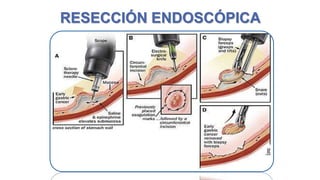 RESECCIÓN ENDOSCÓPICA

 