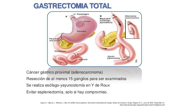 grupos ganglionares estomago pdf c 225 ncer gastrico grupos ganglionares estomago pdf c 225 ncer gastrico