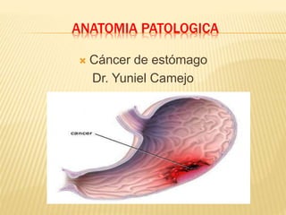 ANATOMIA PATOLOGICA
 Cáncer de estómago
Dr. Yuniel Camejo
 