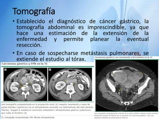 Tomografía
• Establecido el diagnóstico de cáncer gástrico, la
tomografía abdominal es imprescindible, ya que
hace una estimación de la extensión de la
enfermedad y permite planear la eventual
resección.
• En caso de sospecharse metástasis pulmonares, se
extiende el estudio al tórax.
 