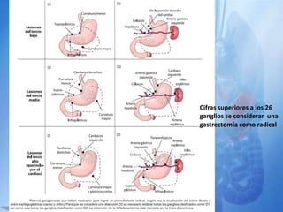 Cifras superiores a los 26
ganglios se considerar una
gastrectomía como radical
 