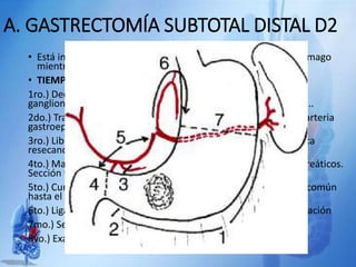 A. GASTRECTOMÍA SUBTOTAL DISTAL D2
• Está indicada en tumores de antro y del tercio medio del estómago
mientras dejen irrigación del tercio superior gástrico
• TIEMPOS OPERATORIOS
1ro.) Decolamiento coloepiploico e investigación de los grupos
ganglionares de la arteria e hilio esplénico y vasos mesentéricos..
2do.) Tratamiento de los ganglios infrapilóricos y ligadura de la arteria
gastroepiploica derecha
3ro.) Liberación y ligadura de la arteria gástrica derecha o pilórica
resecando los ganglios suprapilóricos.
4to.) Maniobra de Kocher e investigación de ganglios retropancreáticos.
Sección y cierre duodenal.
5to.) Curetaje anterior de la arteria hepática en el pedículo y la común
hasta el tronco celíaco.
6to.) Ligadura de la coronaria estomáquica en su origen y extirpación
7mo.) Sección del estómago y reconstrucción del tránsito.
8vo.) Examen de la pieza operatoria
 