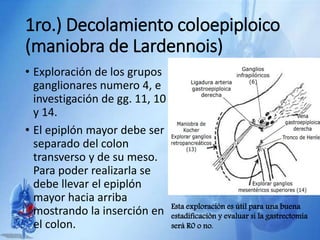 1ro.) Decolamiento coloepiploico
(maniobra de Lardennois)
• Exploración de los grupos
ganglionares numero 4, e
investigación de gg. 11, 10
y 14.
• El epiplón mayor debe ser
separado del colon
transverso y de su meso.
Para poder realizarla se
debe llevar el epiplón
mayor hacia arriba
mostrando la inserción en
el colon.
Esta exploración es útil para una buena
estadificación y evaluar si la gastrectomía
será R0 o no.
 