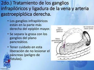 2do.) Tratamiento de los ganglios
infrapilóricos y ligadura de la vena y arteria
gastroepiplóica derecha.
• Los ganglios infrapilóricos
están en la parte más
derecha del epiplón mayor.
• Se separa la grasa con los
ganglios del plano
pancreático.
• Tener cuidado en esta
liberación de no lesionar el
páncreas (peligro de
fístulas).
 