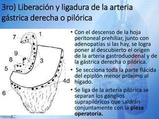 • Con el descenso de la hoja
peritoneal prehiliar, junto con
adenopatías si las hay, se logra
poner al descubierto el origen
de la arteria gastroduodenal y de
la gástrica derecha o pilórica.
• Se secciona toda la parte flácida
del epiplón menor próximo al
hígado.
• Se liga de la artería pilórica se
separan los ganglios
suprapilóricos que saldrán
conjuntamente con la pieza
operatoria.
3ro) Liberación y ligadura de la arteria
gástrica derecha o pilórica
 