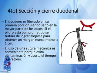 4to) Sección y cierre duodenal
• El duodeno es liberado en su
primera porción siendo sano en la
mayor parte de los casos. Si el
píloro esta comprometido se
tratara de lograr alejarse para
obtener un margen nunca menor a
1 cm.
• El uso de una sutura mecánica es
conveniente porque evita
contaminación y acorta el tiempo
operatorio.
 
