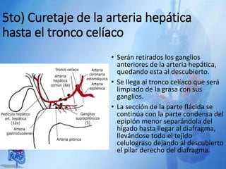 5to) Curetaje de la arteria hepática
hasta el tronco celíaco
• Serán retirados los ganglios
anteriores de la arteria hepática,
quedando esta al descubierto.
• Se llega al tronco celíaco que será
limpiado de la grasa con sus
ganglios.
• La sección de la parte flácida se
continúa con la parte condensa del
epiplón menor separándola del
hígado hasta llegar al diafragma,
llevándose todo el tejido
celulograso dejando al descubierto
el pilar derecho del diafragma.
 