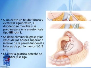 • Si no existe un tejido fibroso y
cicatrizal significativo, el
duodeno se moviliza y se
prepara para una anastomosis
tipo Billroth I.
• Se debe eliminar la grasa y los
vasos de los bordes superior e
inferior de la pared duodenal a
lo largo de por lo menos 1-1,5
cm.
• La arteria gástrica derecha se
identifica y se liga.
 