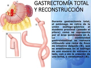 GASTRECTOMÍA TOTAL
Y RECONSTRUCCIÓN
Durante gastrectomía total,
el estómago se retira de la
unión esófago-gástrico al
duodeno proximal (pasado el
píloro) como se representa
por el área sombreada en A.
La continuidad
gastrointestinal se restaura
utilizando una rama de Roux
de intestino delgado (B), que
se anastomosa en el esófago
de una manera de extremo a
lado, con o sin la creación de
una bolsa, o neostomach (B).
 