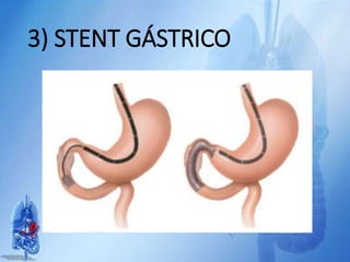 3) STENT GÁSTRICO
 