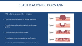 Cancer gastrico | PPTX