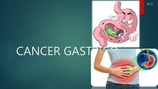 CANCER GASTRICO
M.G.
 