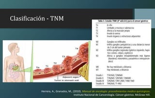 Clasificación - TNM
Herrera, A., Granados, M., (2010). Manual de oncología: procedimientos medico quirúrgicos.
Instituto Nacional de Cancerología. Cáncer gástrico. McGraw Hill.
 