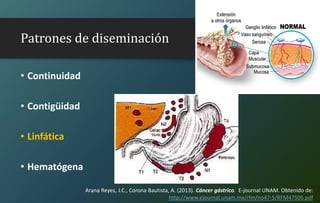 Patrones de diseminación
• Continuidad
• Contigüidad
• Linfática
• Hematógena
Arana Reyes, J.C., Corona Bautista, A. (2013). Cáncer gástrico. E-journal UNAM. Obtenido de:
http://www.ejournal.unam.mx/rfm/no47-5/RFM47506.pdf
 