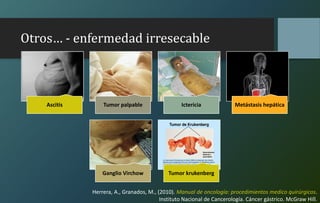Otros… - enfermedad irresecable
Ascitis Tumor palpable Ictericia Metástasis hepática
Ganglio Virchow Tumor krukenberg
Herrera, A., Granados, M., (2010). Manual de oncología: procedimientos medico quirúrgicos.
Instituto Nacional de Cancerología. Cáncer gástrico. McGraw Hill.
 