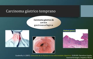 Carcinoma gástrico temprano
Carcinoma gástrico de
u n ión
gastroes ofágica
Caudevilla, A. (2007). Evaluación de la displasia en las enfermedades digestivas. ELSEVIER. Barcelona España.
Gastroenterología y hepática 30(10).
 