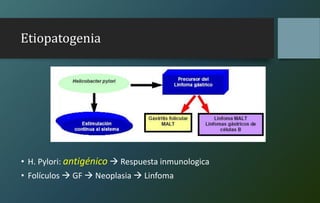 Etiopatogenia
• H. Pylori: antigénico  Respuesta inmunologica
• Folículos  GF  Neoplasia  Linfoma
 
