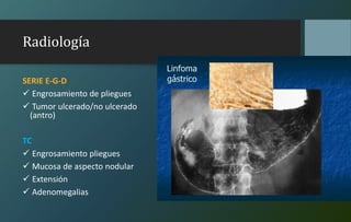 Radiología
SERIE E-G-D
 Engrosamiento de pliegues
 Tumor ulcerado/no ulcerado
(antro)
TC
 Engrosamiento pliegues
 Mucosa de aspecto nodular
 Extensión
 Adenomegalias
 