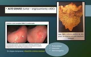 • ALTO GRADO: tumor – engrosamiento «ADC»
 Profundidad
 Extensión
 AdenomegaliasEn etapas tempranas «Gastritis crónica erosiva»
 