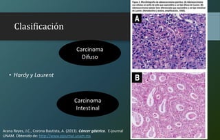 Clasificación
• Hardy y Laurent
Carcinoma
Intestinal
Carcinoma
Difuso
Arana Reyes, J.C., Corona Bautista, A. (2013). Cáncer gástrico. E-journal
UNAM. Obtenido de: http://www.ejournal.unam.mx
 