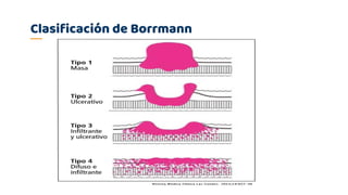Boreman Classification Cancer gastrico | PDF