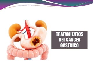 TRATAMIENTOS
DEL CANCER
GASTRICO
 