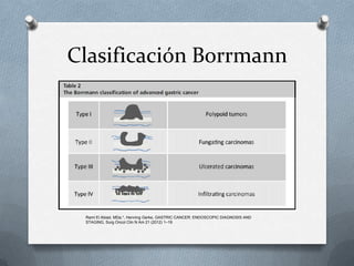 Boreman Classification Cancer gastrico caso | PPTX