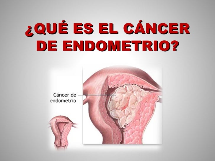 cancer ginecologico tesis