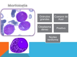 Gránulos     Cuerpos de
grandes        Auer


Citoplasma
              Positivo
   denso


        Núcleo
       reniforme
 