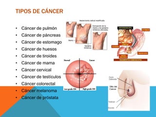 TIPOS DE CÁNCER

• Cáncer de pulmón
• Cáncer de páncreas
• Cáncer de estomago
• Cáncer de huesos
• Cáncer de tiroides
• Cáncer de mama
• Cáncer cervical
• Cáncer de testículos
• Cáncer colorectal
• Cáncer melanoma
• Cáncer de próstata
 
