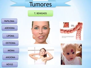 Tumores
T. BENIGNOS
PAPILOMA
ADENOMA
LIPOMA
OSTEOMA
MIOMA
ANGIOMA
NEVUS

 