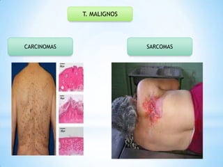 T. MALIGNOS

CARCINOMAS

SARCOMAS

 