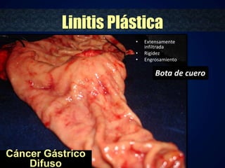 Linitis Plástica 
• Extensamente 
infiltrada 
• Rigidez 
• Engrosamiento 
Cáncer Gástrico 
Difuso 
Bota de cuero 
 