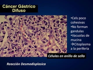 Cáncer Gástrico 
Difuso 
•Cels poco 
cohesivas 
•No forman 
gandulas 
•Vacuolas de 
mucina 
Citoplasma 
a la periferia 
Células en anillo de sello 
Reacción Desmodisplasica 
 