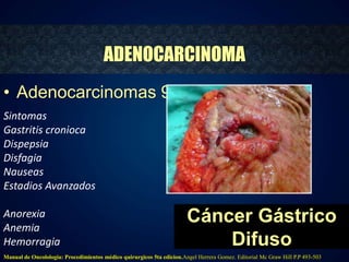 ADENOCARCINOMA 
Cáncer Gástrico 
Difuso 
• Adenocarcinomas 95% 
Sintomas 
Gastritis cronioca 
Dispepsia 
Disfagia 
Nauseas 
Estadios Avanzados 
Anorexia 
Anemia 
Hemorragia 
Manual de Oncolologia: Procedimientos médico quirurgicos 5ta edicion.Angel Herrera Gomez. Editorial Mc Graw Hill P.P 493-503 
 