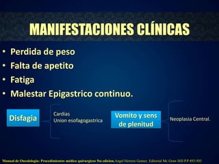 MANIFESTACIONES CLÍNICAS 
• Perdida de peso 
• Falta de apetito 
• Fatiga 
• Malestar Epigastrico continuo. 
Disfagia 
Cardias 
Union esofagogastrica 
Vomito y sens 
de plenitud 
Neoplasia Central. 
Manual de Oncolologia: Procedimientos médico quirurgicos 5ta edicion.Angel Herrera Gomez. Editorial Mc Graw Hill P.P 493-503 
 