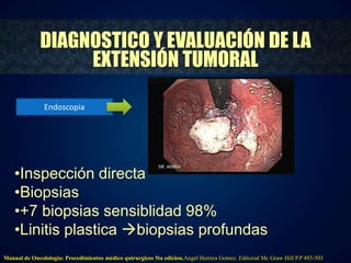 DIAGNOSTICO Y EVALUACIÓN DE LA 
EXTENSIÓN TUMORAL 
Endoscopia 
•Inspección directa 
•Biopsias 
•+7 biopsias sensiblidad 98% 
•Linitis plastica biopsias profundas 
Manual de Oncolologia: Procedimientos médico quirurgicos 5ta edicion.Angel Herrera Gomez. Editorial Mc Graw Hill P.P 493-503 
 