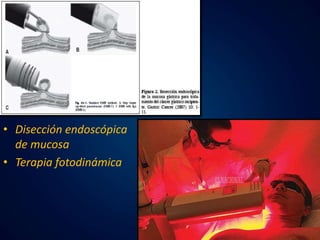 • Disección endoscópica 
de mucosa 
• Terapia fotodinámica 
 