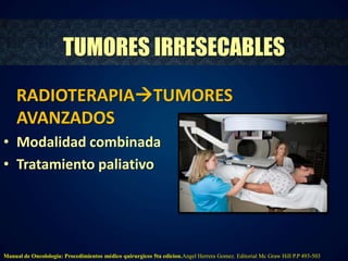 TUMORES IRRESECABLES 
RADIOTERAPIATUMORES 
AVANZADOS 
• Modalidad combinada 
• Tratamiento paliativo 
Manual de Oncolologia: Procedimientos médico quirurgicos 5ta edicion.Angel Herrera Gomez. Editorial Mc Graw Hill P.P 493-503 
 