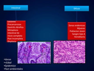 Intestinal Difuso 
Lesiones 
Precancerosas 
Gastritis Atrofica 
Metaplasia 
intestinal de 
inicio completo 
Post incompleta 
Displasia 
Zonas endemicas 
Mjueres 
Poblacion Joven 
Sangre tipo A 
Hereditario 
•Varon 
•+Edad 
•Epidemico 
•Fact ambientales 
 