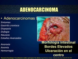 ADENOCARCINOMA 
Morfologia intestinal 
Bordes Elevados 
Ulceración en el 
centro 
• Adenocarcinomas 95% 
Sintomas 
Gastritis cronioca 
Dispepsia 
Disfagia 
Nauseas 
Estadios Avanzados 
Anorexia 
Anemia 
Hemorragia 
Manual de Oncolologia: Procedimientos médico quirurgicos 5ta edicion.Angel Herrera Gomez. Editorial Mc Graw Hill P.P 493-503 
 
