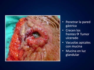 • Penetrar la pared 
gástrica 
• Crecen los 
frentes Tumor 
ulcerado 
• Vacuolas apicales 
con mucina 
• Mucina en luz 
glandular 
 
