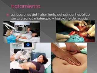  Las opciones del tratamiento del cáncer hepático
son cirugía, quimioterapia y trasplante de hígado
 