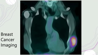 Breast
Cancer
Imaging
 