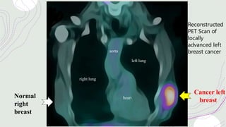 right lung
left lung
heart
Normal
right
breast
Cancer left
breast
aorta
Reconstructed
PET Scan of
locally
advanced left
breast cancer
 