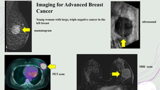 Imaging for Advanced Breast
Cancer
Young woman with large, triple negative cancer in the
left breast
mammogram
ultrasound
PET scan
MRI scan
 