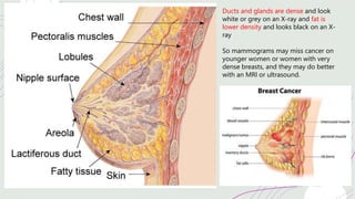 Ducts and glands are dense and look
white or grey on an X-ray and fat is
lower density and looks black on an X-
ray
So mammograms may miss cancer on
younger women or women with very
dense breasts, and they may do better
with an MRI or ultrasound.
 